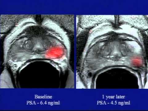 TED】席捲全球的美國飲食殺手--迪安-奧尼什｜TEDxPenn (【TED】The killer American diet that's sweeping the planet | Dean Ornish | TEDxPenn)