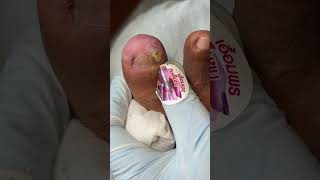 Ep_8159 Ingrown toenail removal 👣 The skin here... peels off like this 😄 (clip from Thailand)