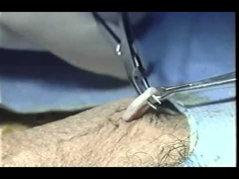 No-Scalpel Vasectomy (NSV)  