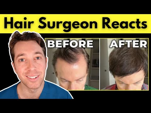 Bryan Johnson's Hair Loss | Hair Surgeon Reacts