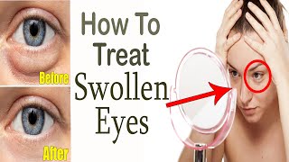 How to Get Rid of Swollen Eyes at Home || Home Remedies for Swollen Eyes || Puffy Eyes Treatment