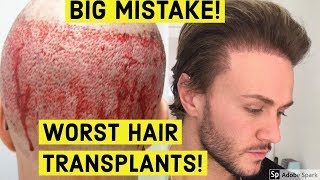 WORST HAIR TRANSPLANT RESULTS EVER!