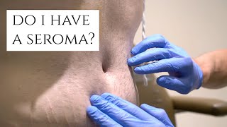 What is a Seroma? | Fluid Build Up After Surgery | Symptoms and Treatment | Dr. Daniel Barrett