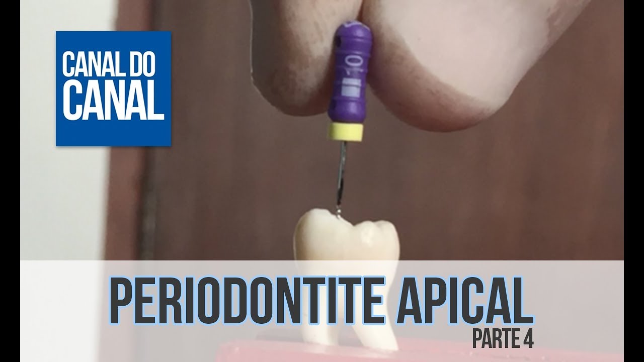 Video 9 - Periodontite Apical - parte 4