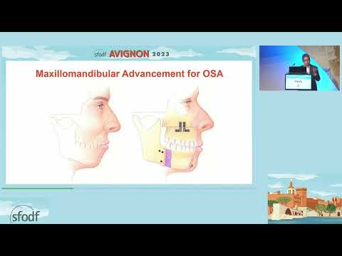 Sleep Apnea Surgery: My Perspective