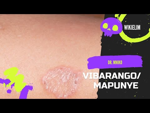 VIBARANGO/ MAPUNYE / MASHILINGI : Sababu, dalili, matibabu na Nini cha kufanya