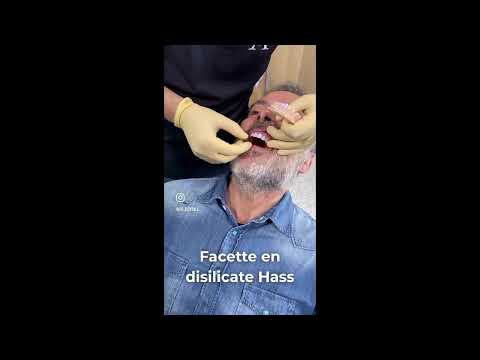 Disilicate en hass – Esthétique