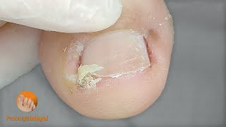 Ingrown toenails from improper trimming | Correction to eliminate discomfort immediately