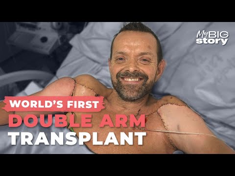 This Man Got the First Double-Arm Transplant