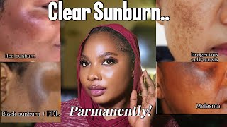 Download lagu Best Brightening products for SUNBURN✅ | How to clear sunburn permanently!  mp3