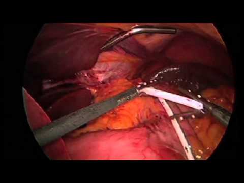 download lagu mp3 mp4 Lap Band Surgery Procedure Video, download lagu Lap Band Surgery Procedure Video gratis, unduh video klip Lap Band Surgery Procedure Video
