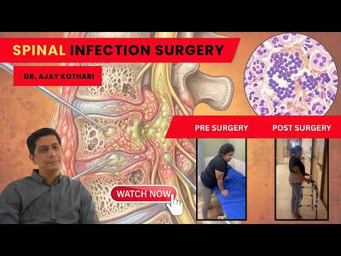Patient Testimonials | Dr. Ajay Kothari - Minimally invasive endoscopic, scoliosis & Spine Surgeon | Shivaji Nagar, Pune