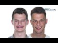 Jaw surgery Case # 105: Gustavo - Short face, overbite, maxilo-mandibular retrusion