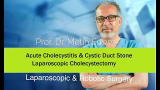 Miniaturka - Acute Cholecystitis.& Cystic duct Stone. Metin Ertem MD.FACS