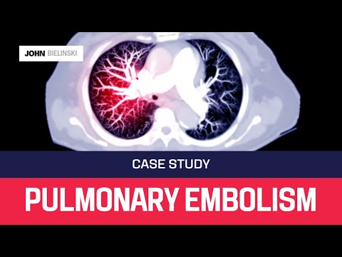 Case Study and Insights on Pulmonary Embolism