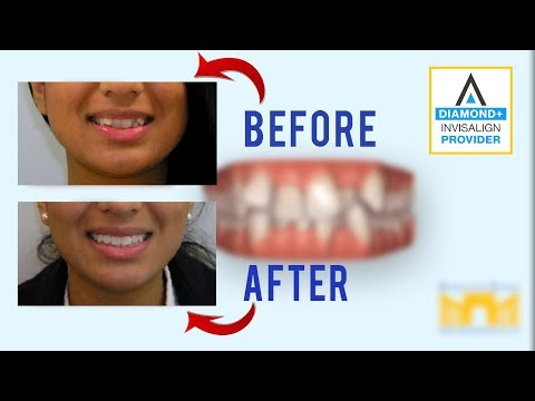 Invisalign Before and After: Crowded Teeth