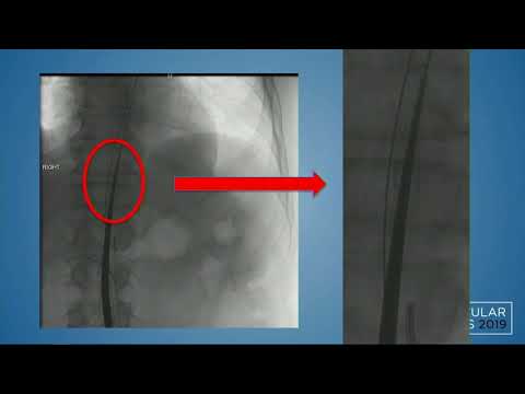 CVI 2019_Friday 7/19_ Aortoiliac Disease _Jessica Titus, MD