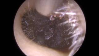 Dark Brown Ear Wax Removed from Ear Canal - Mr Neel Raithatha (The Hear Clinic)