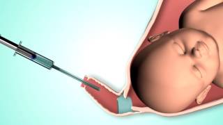 GYNOTAL OBSTETRIC GEL STERILE