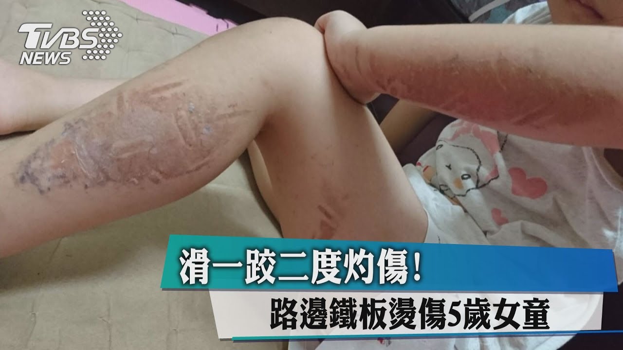 滑一跤二度灼傷! 路邊鐵板燙傷5歲女童