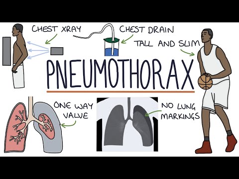 Pneumothorax