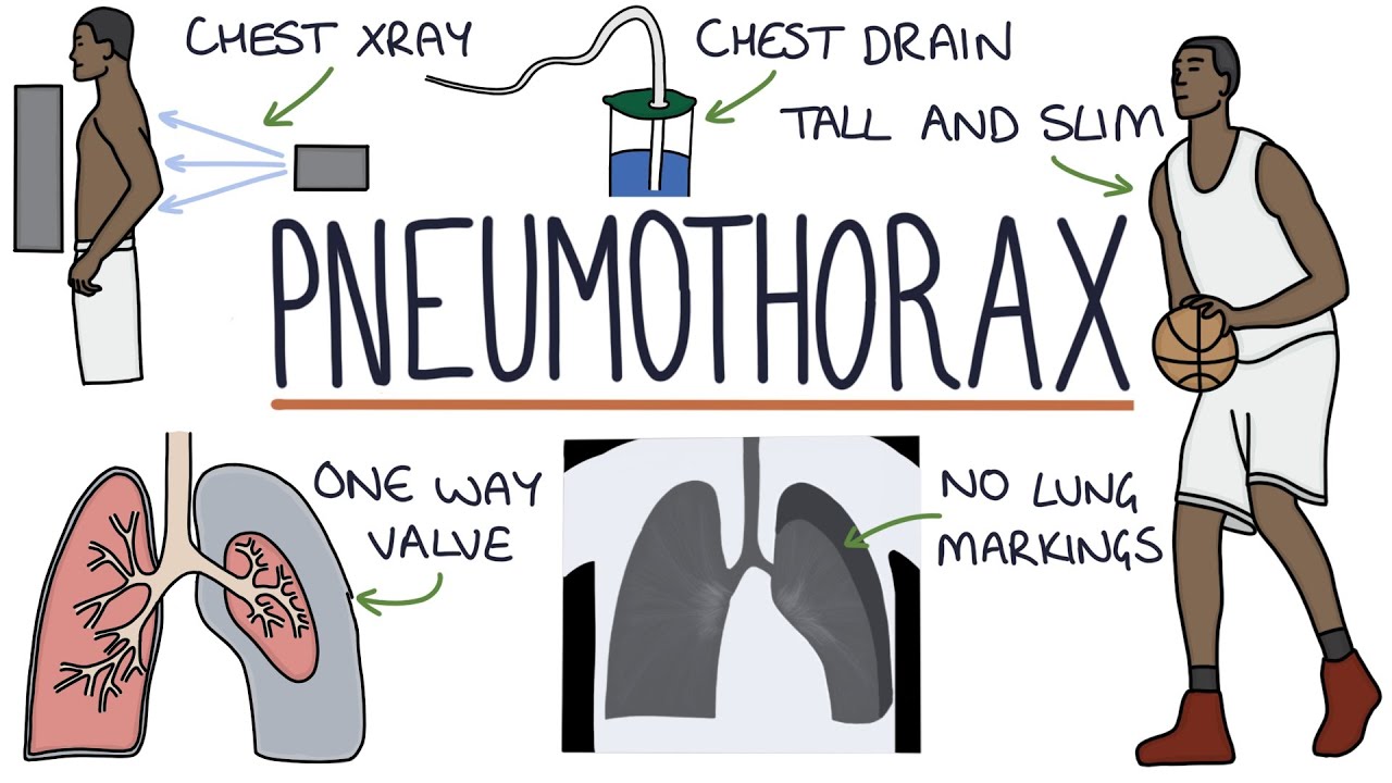 Pneumothorax