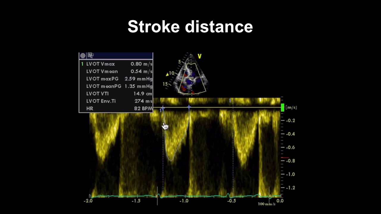 Echocardiography Essentials: Assessing left ventricular global systolic function (LVF)