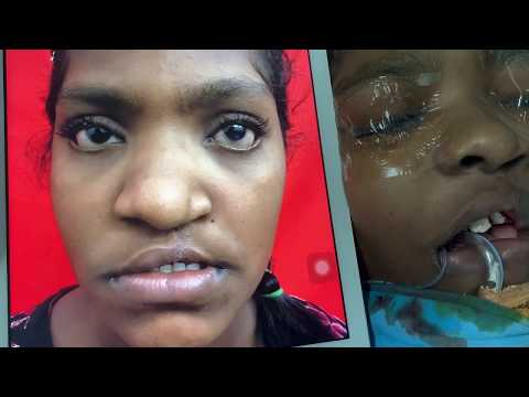 Distraction Osteogenesis In Maxillofacial Surgery