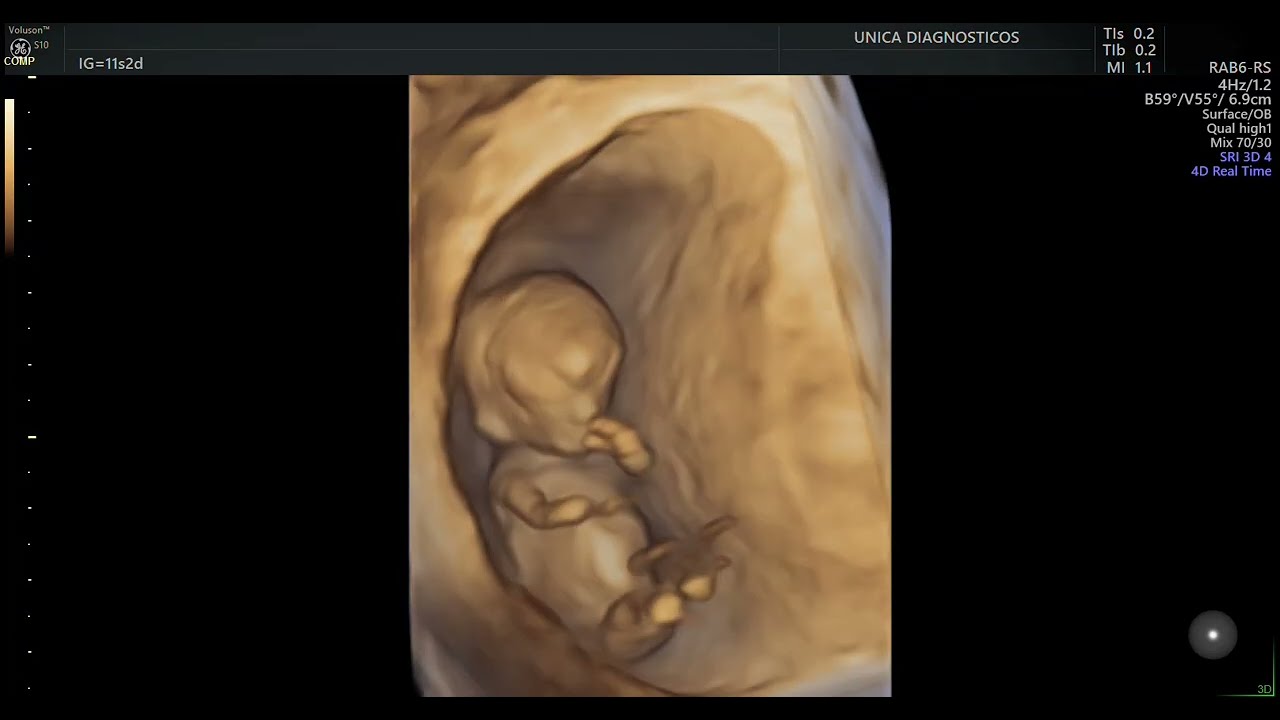 Ultrassom 4D em gestação de 12 semanas - 1