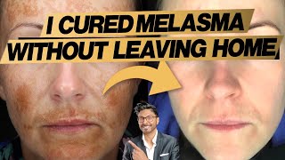 Melasma Treatment At Home: Expert Doctor