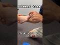 Treating Hammer Toes With A Orthotic And Met Pads Is My First Line Of Treatment Physiotherapy