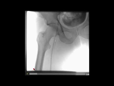 Don't Put IVC Filters Where They Don't Belong - John Tyler, MD; Neil E. Strickman, MD