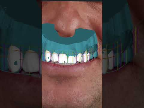 DESIGN The PERFECT Smile 👌 #cosmeticdentistry #smilemakeover #cadcam #digitalsmiledesign #dentist