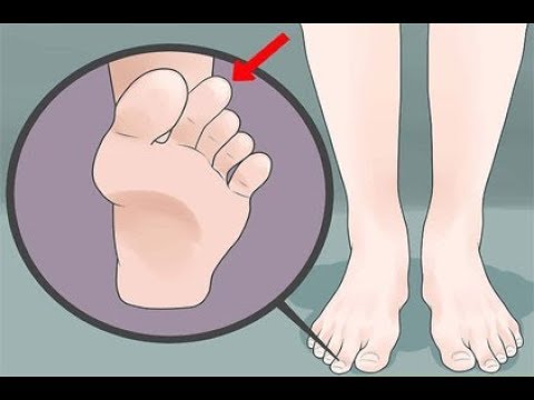 Shiin Osteochondrose Foto Kopfschmerzen Hals und das linke Auge