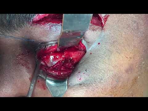 Orbital Floor Impure Blowout Fracture Treated Via Blepharoplasty Approach