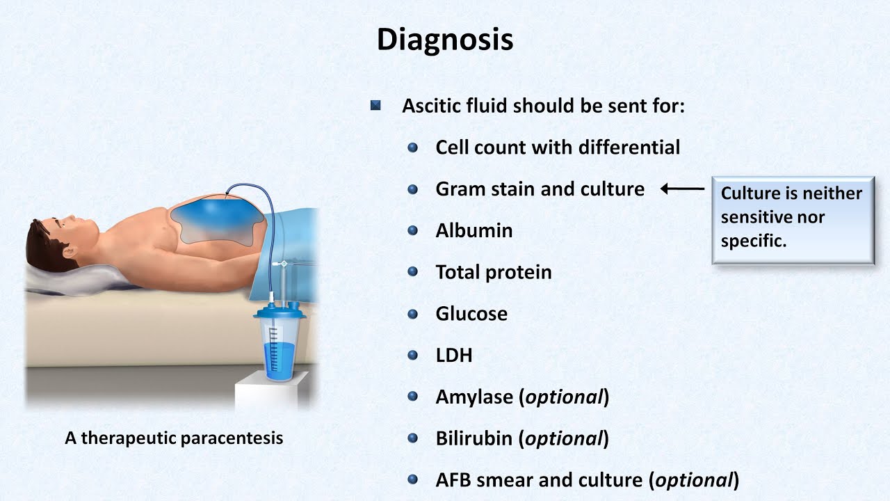 Spontaneous Bacterial Peritonitis
