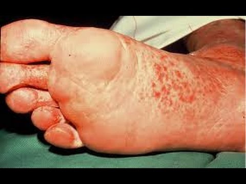 Geranium oil laban kuko halamang-singaw Yodo pahid kuko halamang-singaw sa aking mga paa