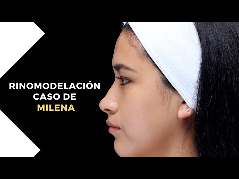 Caso de MILENA