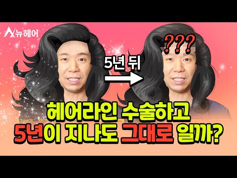 헤어라인 교정 수술 5년 뒤에도 그대로 일까?｜모발이식｜뉴헤어