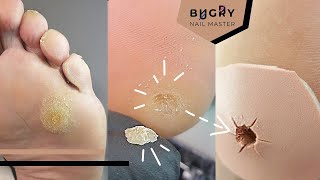 ¿Callo o dureza en los pies😱 Aquí lo resolvemos! Tutorial de pedicura