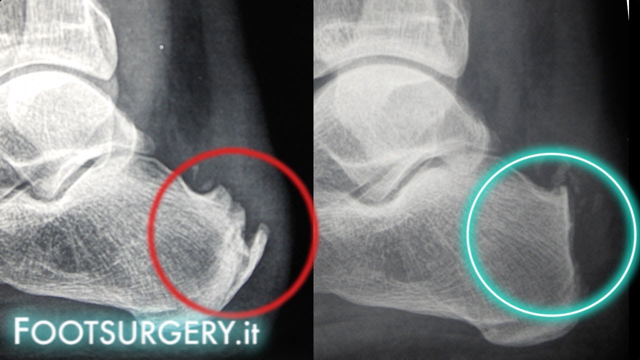 Malattia di Haglund, un mese dopo l'intervento
