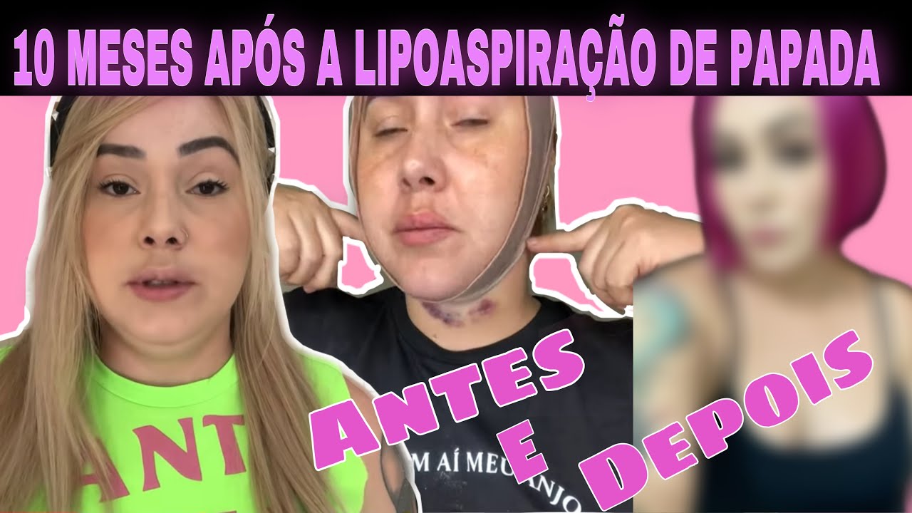ANTES E DEPOIS DA MINHA LIPOAPIRAÇÃO DE PAPADA CIRURGICA - LIPO DE PAPADA