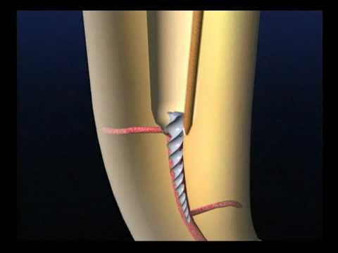 Remoção de Instrumento Fraturado com Ultrassom - Animação