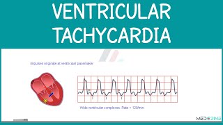 Ventricular Tachycardia (VTach) Explained | ECG Interpretation for Medical & Nursing Students