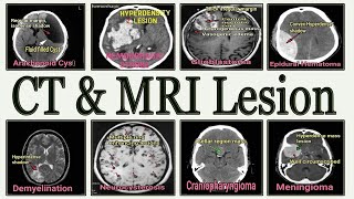 CT & MRI lesions