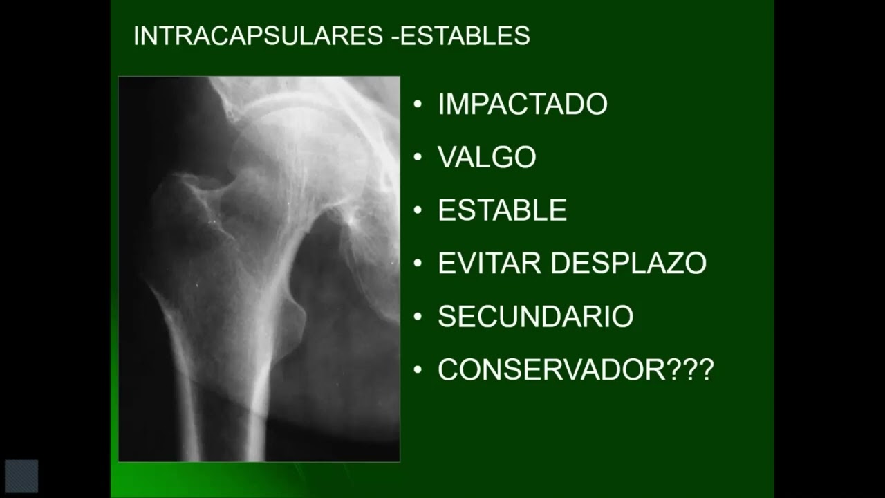 Los grandes síndromes ortopédicos-geriátricos-Las Caídas