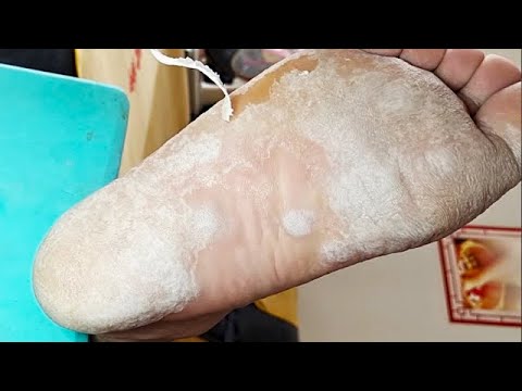 Amazing，All foot coverd with dry callus