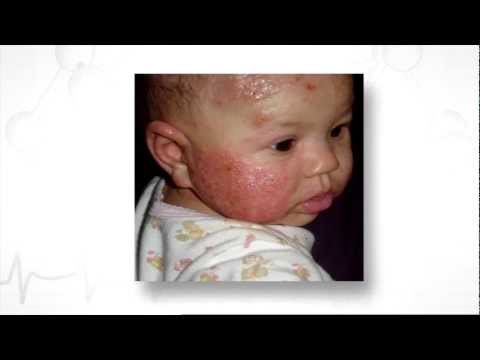 Kuko halamang-singaw paggamot klinika Paggamot ng warts kuko wagbarnis