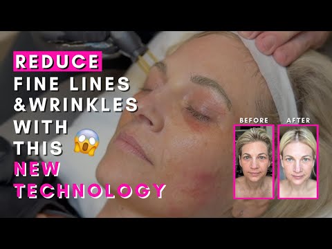 The #1 Skin Treatment for Flawless Results with Zero Downtime - NeoGen Interview