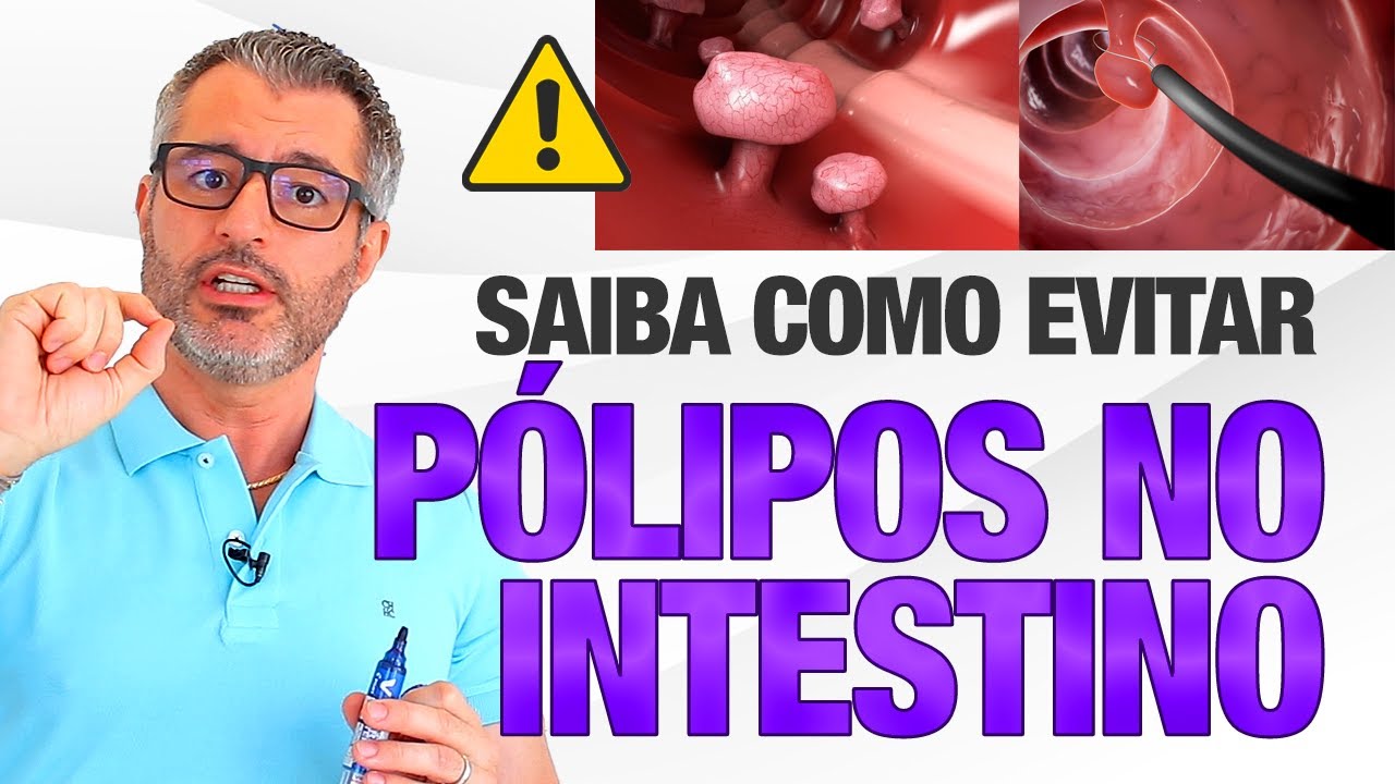 O que você precisa saber para evitar PÓLIPOS